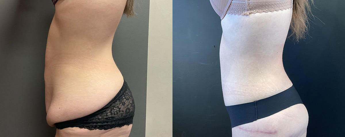 Abdominoplasty (Tummy Tuck) Before & After Gallery - Patient 287545 - Image 2