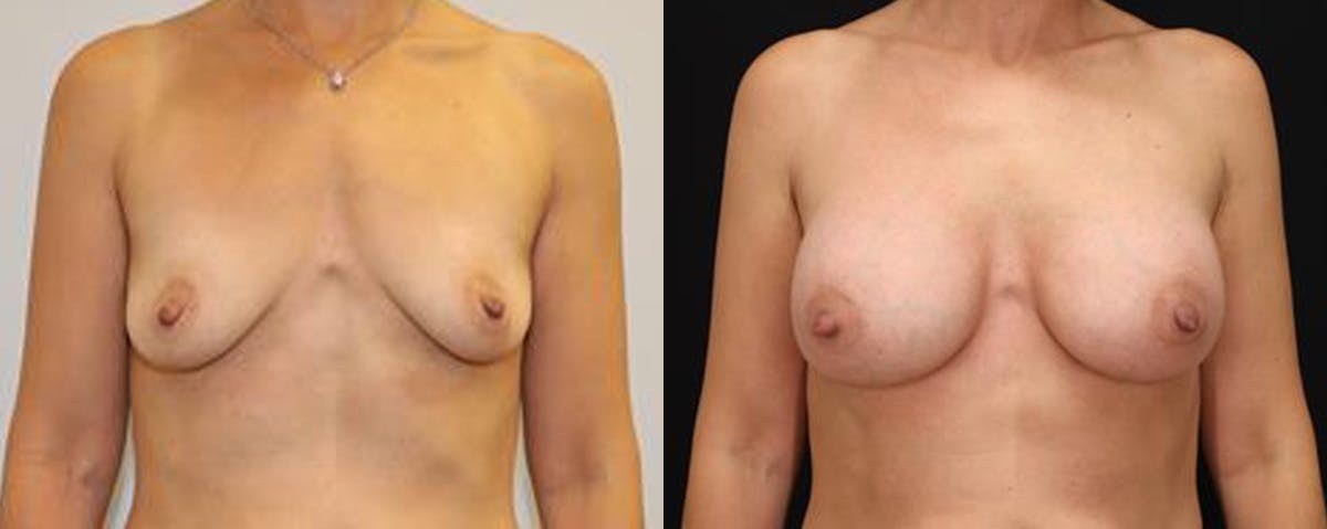 Breast Augmentation Before & After Gallery - Patient 269263 - Image 1