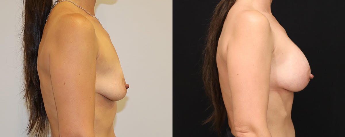 Breast Augmentation Before & After Gallery - Patient 269263 - Image 3
