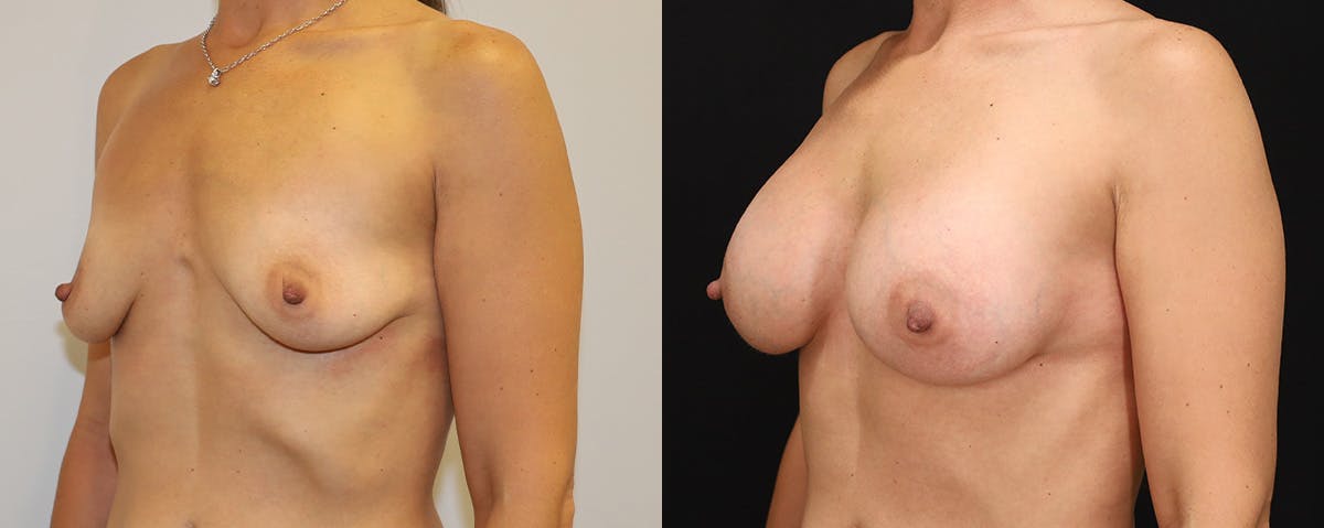 Breast Augmentation Before & After Gallery - Patient 269263 - Image 2