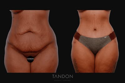 Abdominoplasty (Tummy Tuck) Before & After Gallery - Patient 232553 - Image 1