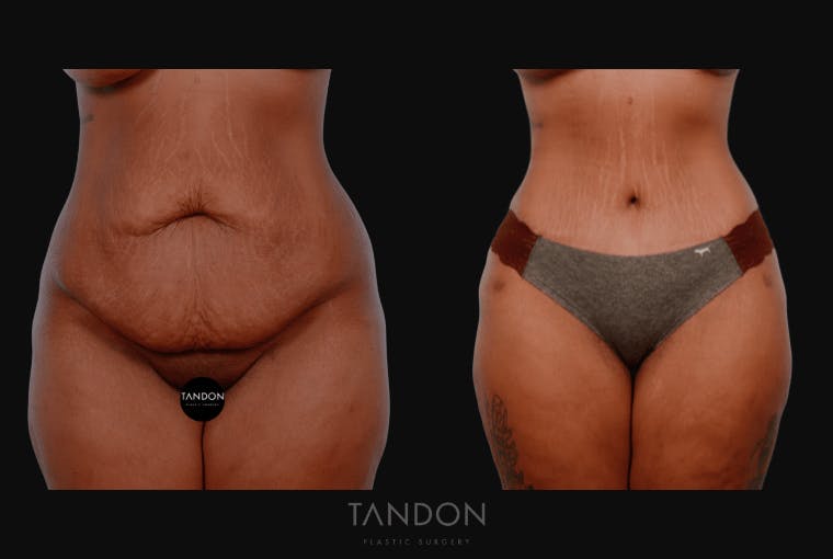 Abdominoplasty (Tummy Tuck) Before & After Gallery - Patient 232553 - Image 1