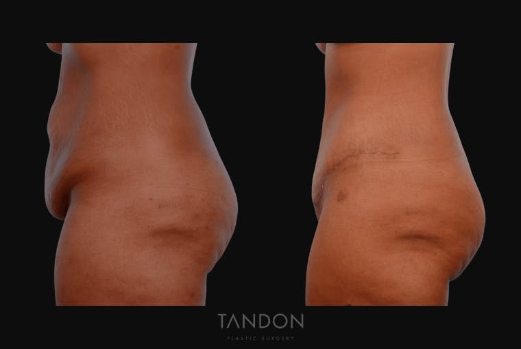 Abdominoplasty (Tummy Tuck) Before & After Gallery - Patient 232553 - Image 5