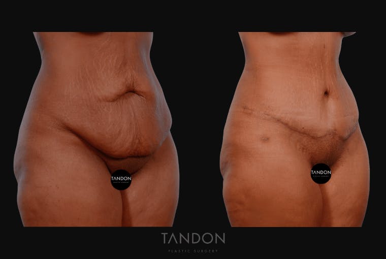 Abdominoplasty (Tummy Tuck) Before & After Gallery - Patient 232553 - Image 2