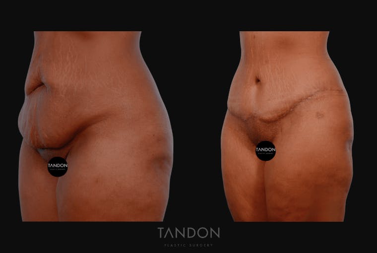 Abdominoplasty (Tummy Tuck) Before & After Gallery - Patient 232553 - Image 4