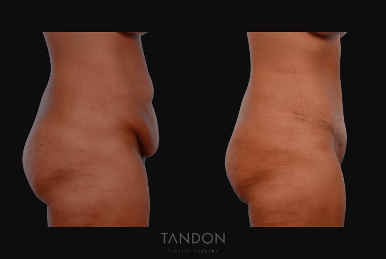 Abdominoplasty (Tummy Tuck) Before & After Gallery - Patient 232553 - Image 3