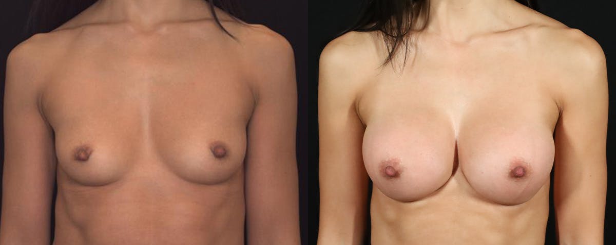 Breast Augmentation Before & After Gallery - Patient 418825 - Image 1
