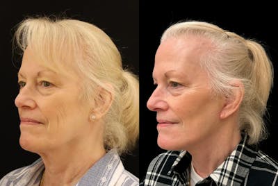Facelift Before & After Gallery - Patient 642586 - Image 1