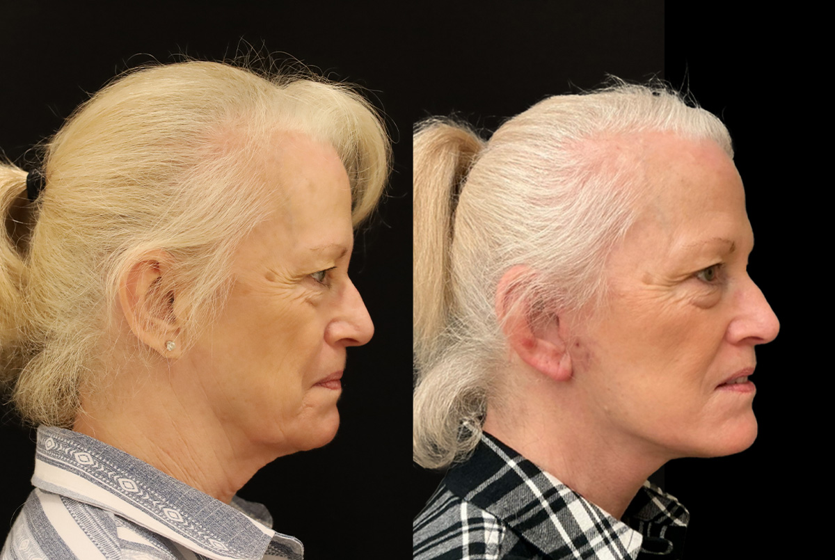 Patient 642586 | Facelift Before & After Photos | Boston Center