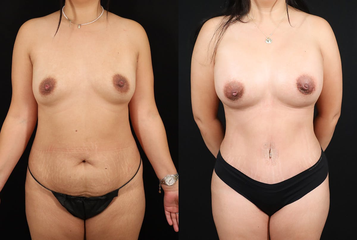 Mommy Makeover Before & After Gallery - Patient 200105 - Image 1