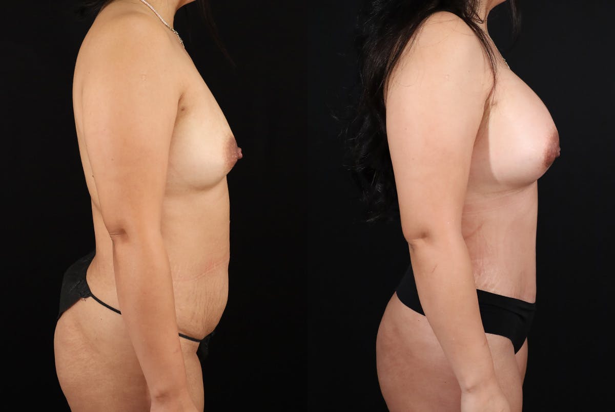 Mommy Makeover Before & After Gallery - Patient 200105 - Image 4