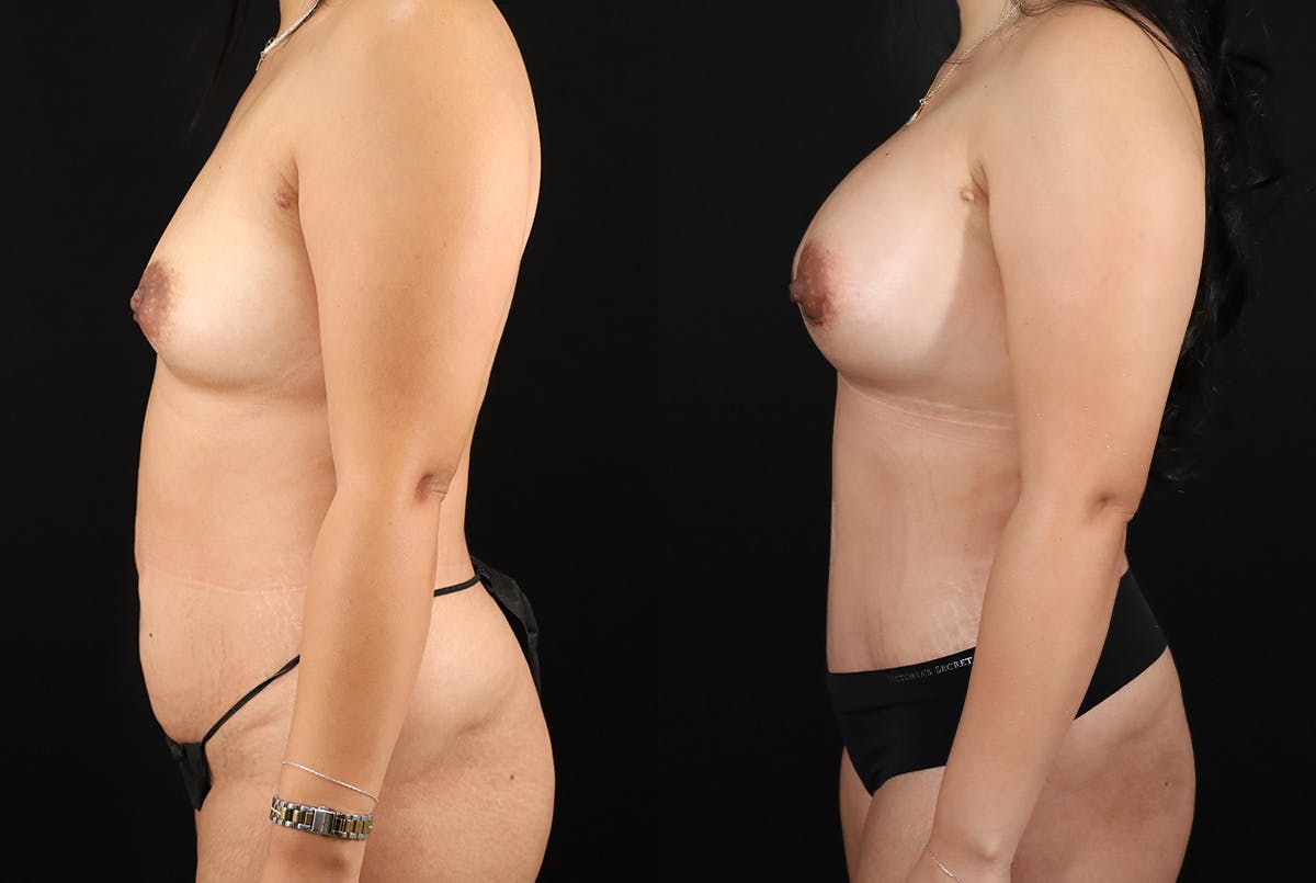 Mommy Makeover Before & After Gallery - Patient 200105 - Image 3