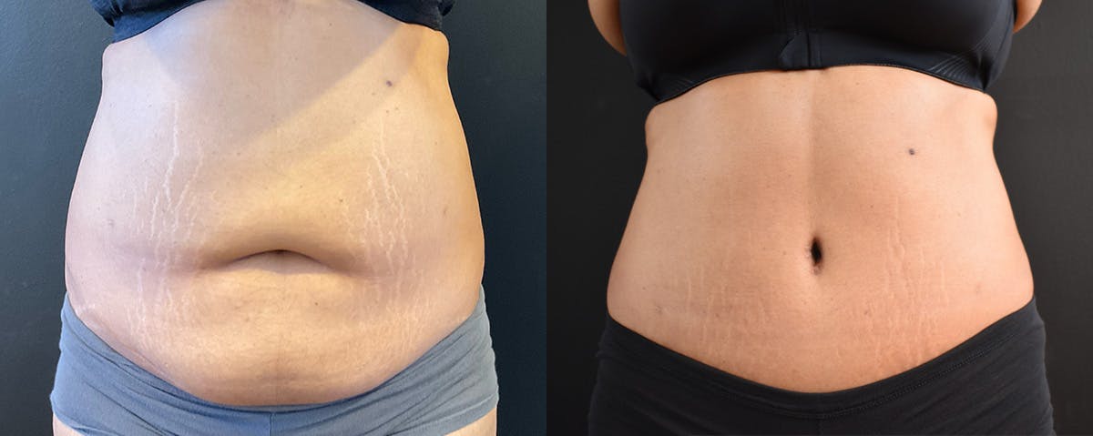 Abdominoplasty (Tummy Tuck) Before & After Gallery - Patient 294999 - Image 1