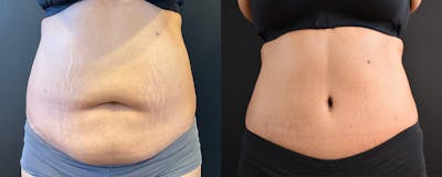 Abdominoplasty (Tummy Tuck) Before & After Gallery - Patient 294999 - Image 1
