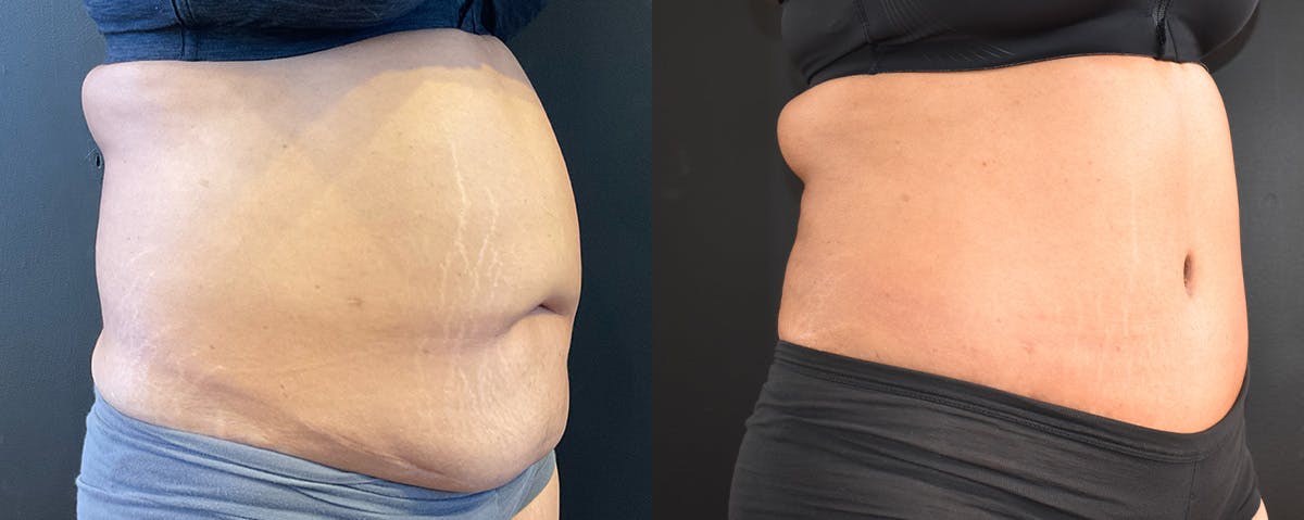 Abdominoplasty (Tummy Tuck) Before & After Gallery - Patient 294999 - Image 2