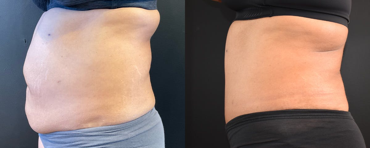 Abdominoplasty (Tummy Tuck) Before & After Gallery - Patient 294999 - Image 3