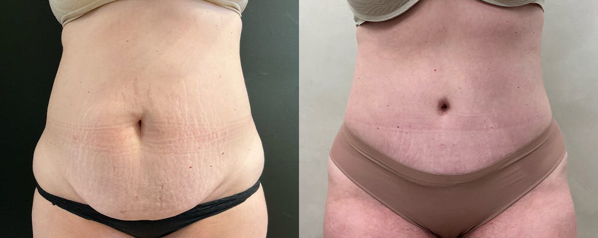 Abdominoplasty (Tummy Tuck) Before & After Gallery - Patient 324335 - Image 1