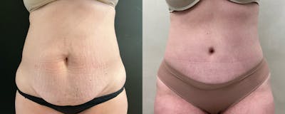 Abdominoplasty (Tummy Tuck) Before & After Gallery - Patient 324335 - Image 1
