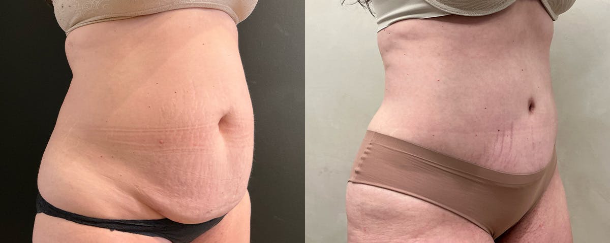 Abdominoplasty (Tummy Tuck) Before & After Gallery - Patient 324335 - Image 2
