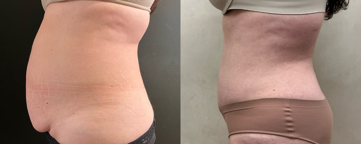 Abdominoplasty (Tummy Tuck) Before & After Gallery - Patient 324335 - Image 3