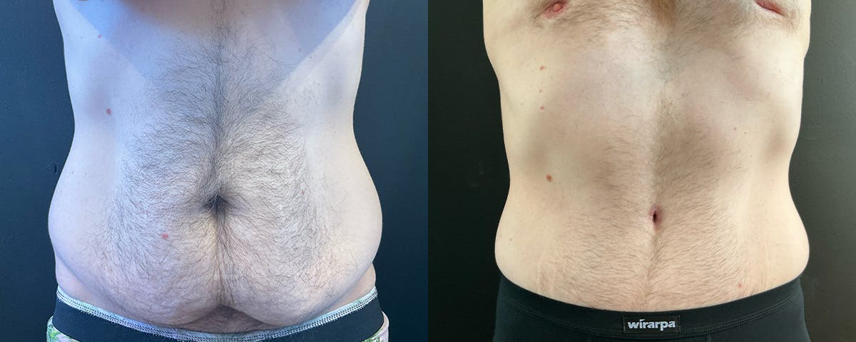 Abdominoplasty (Tummy Tuck) Before & After Gallery - Patient 363015 - Image 1