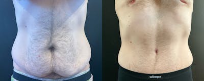 Abdominoplasty (Tummy Tuck) Before & After Gallery - Patient 363015 - Image 1