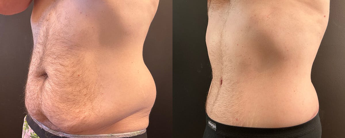 Abdominoplasty (Tummy Tuck) Before & After Gallery - Patient 363015 - Image 2