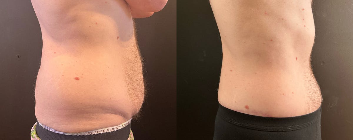 Abdominoplasty (Tummy Tuck) Before & After Gallery - Patient 363015 - Image 3