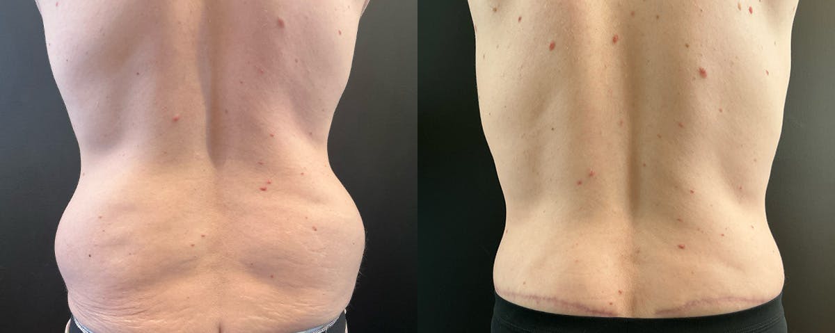 Abdominoplasty (Tummy Tuck) Before & After Gallery - Patient 363015 - Image 4
