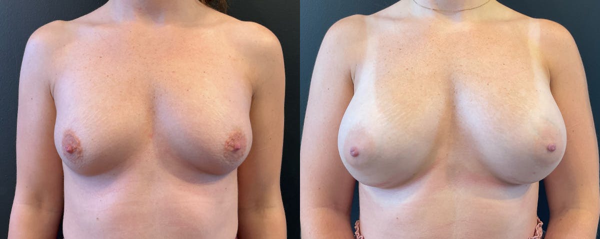 Breast Augmentation Before & After Gallery - Patient 402240 - Image 1
