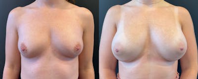 Breast Augmentation Before & After Gallery - Patient 402240 - Image 1