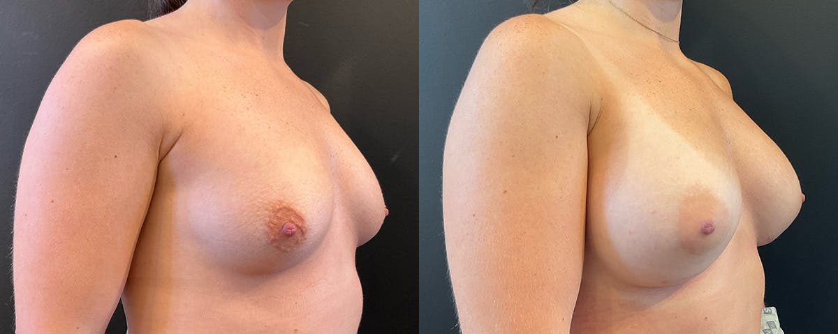 Breast Augmentation Before & After Gallery - Patient 402240 - Image 2