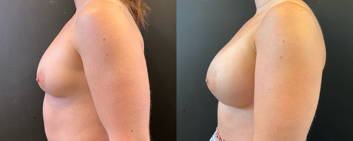 Breast Augmentation Before & After Gallery - Patient 402240 - Image 3