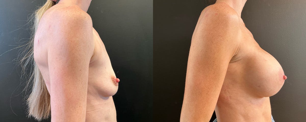 Breast Augmentation Before & After Gallery - Patient 255920 - Image 3