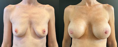 Breast Augmentation Before & After Gallery - Patient 255920 - Image 1