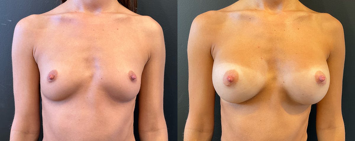 Breast Augmentation Before & After Gallery - Patient 375418 - Image 1