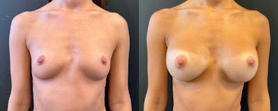 Breast Augmentation Before & After Gallery - Patient 375418 - Image 1
