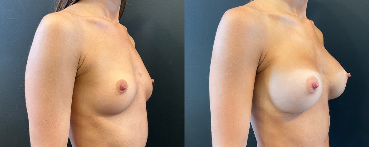 Breast Augmentation Before & After Gallery - Patient 375418 - Image 2