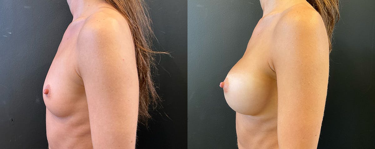 Breast Augmentation Before & After Gallery - Patient 375418 - Image 3