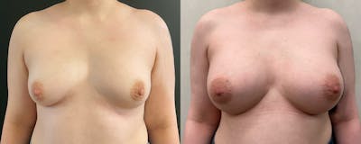 Breast Augmentation Before & After Gallery - Patient 249728 - Image 1