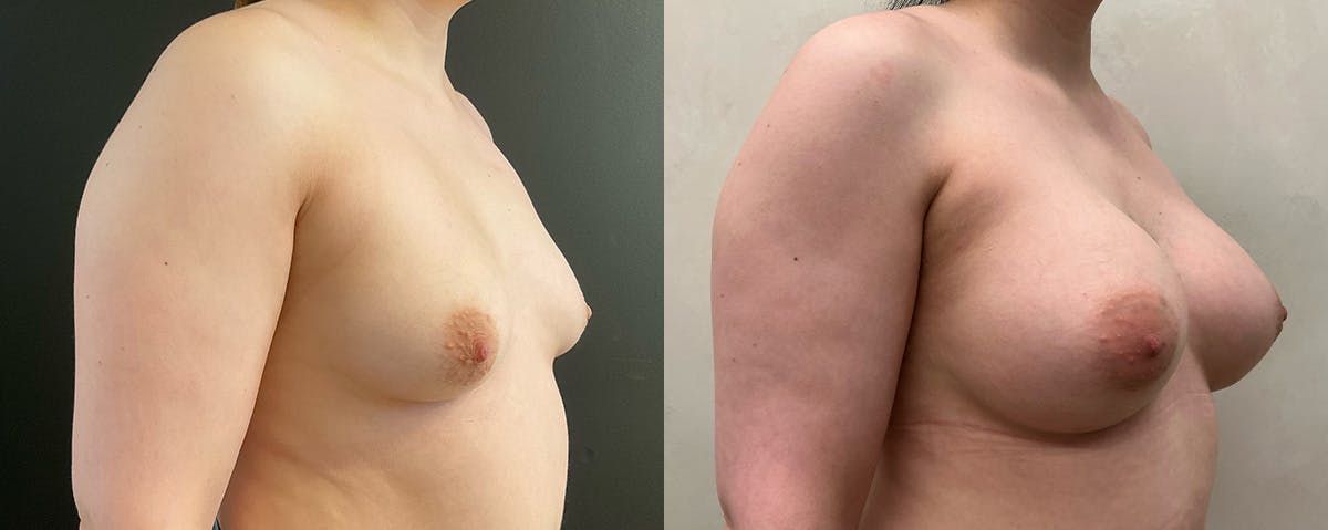 Breast Augmentation Before & After Gallery - Patient 249728 - Image 2