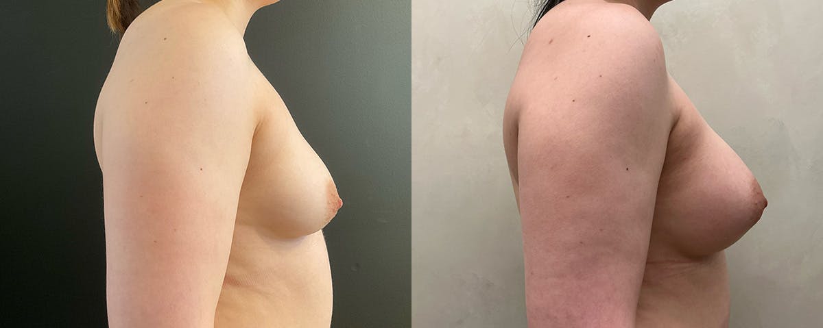 Breast Augmentation Before & After Gallery - Patient 249728 - Image 3