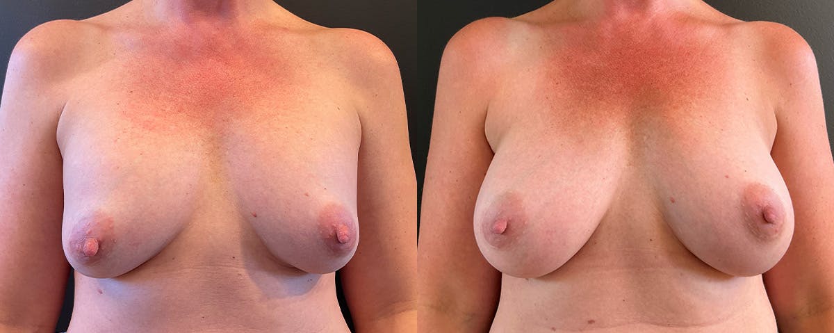 Breast Implant Exchange Before & After Gallery - Patient 162641 - Image 1