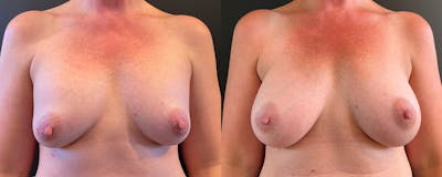 Breast Implant Exchange Before & After Gallery - Patient 162641 - Image 1