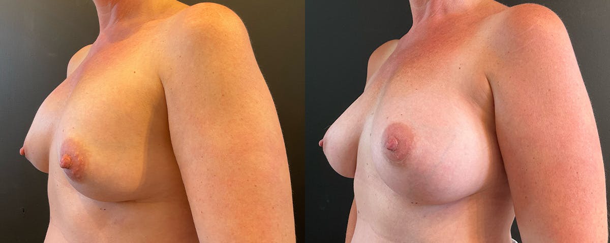 Breast Implant Exchange Before & After Gallery - Patient 162641 - Image 2