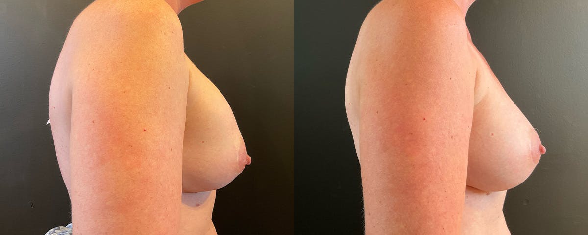 Breast Implant Exchange Before & After Gallery - Patient 162641 - Image 3