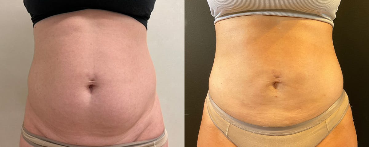 Liposuction Before & After Gallery - Patient 187807 - Image 1