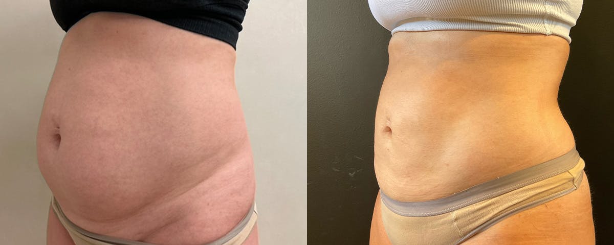 Liposuction Before & After Gallery - Patient 187807 - Image 2