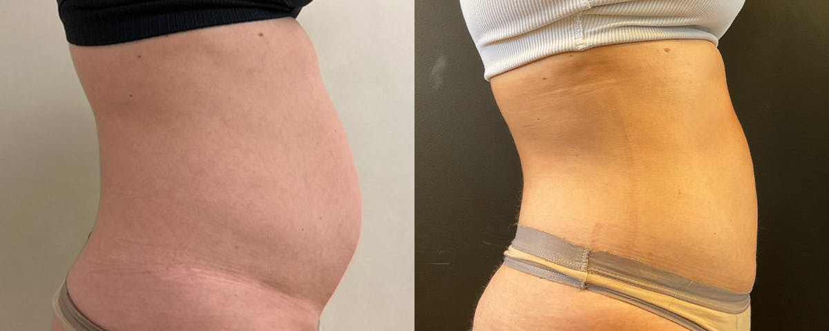 Liposuction Before & After Gallery - Patient 187807 - Image 3