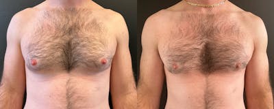 Male Breast Reduction (Gynecomastia) Before & After Gallery - Patient 162210 - Image 1